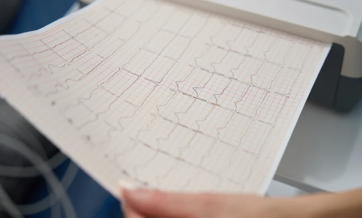 ECG